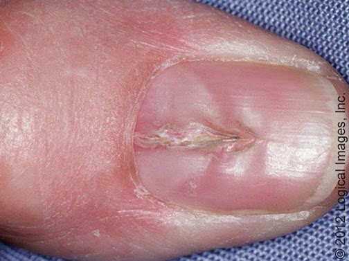 nail dystrophy
