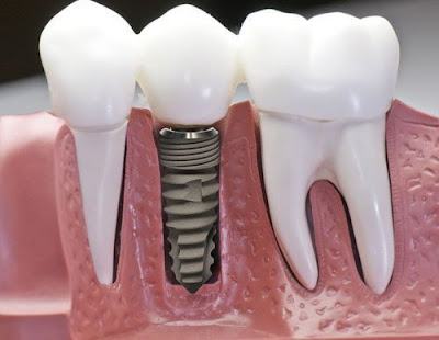 Cấy ghép implant để phục hồi hàm răng