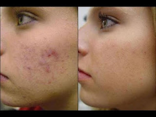 How Much Does It Cost To Get Acne Scars Removed ?
