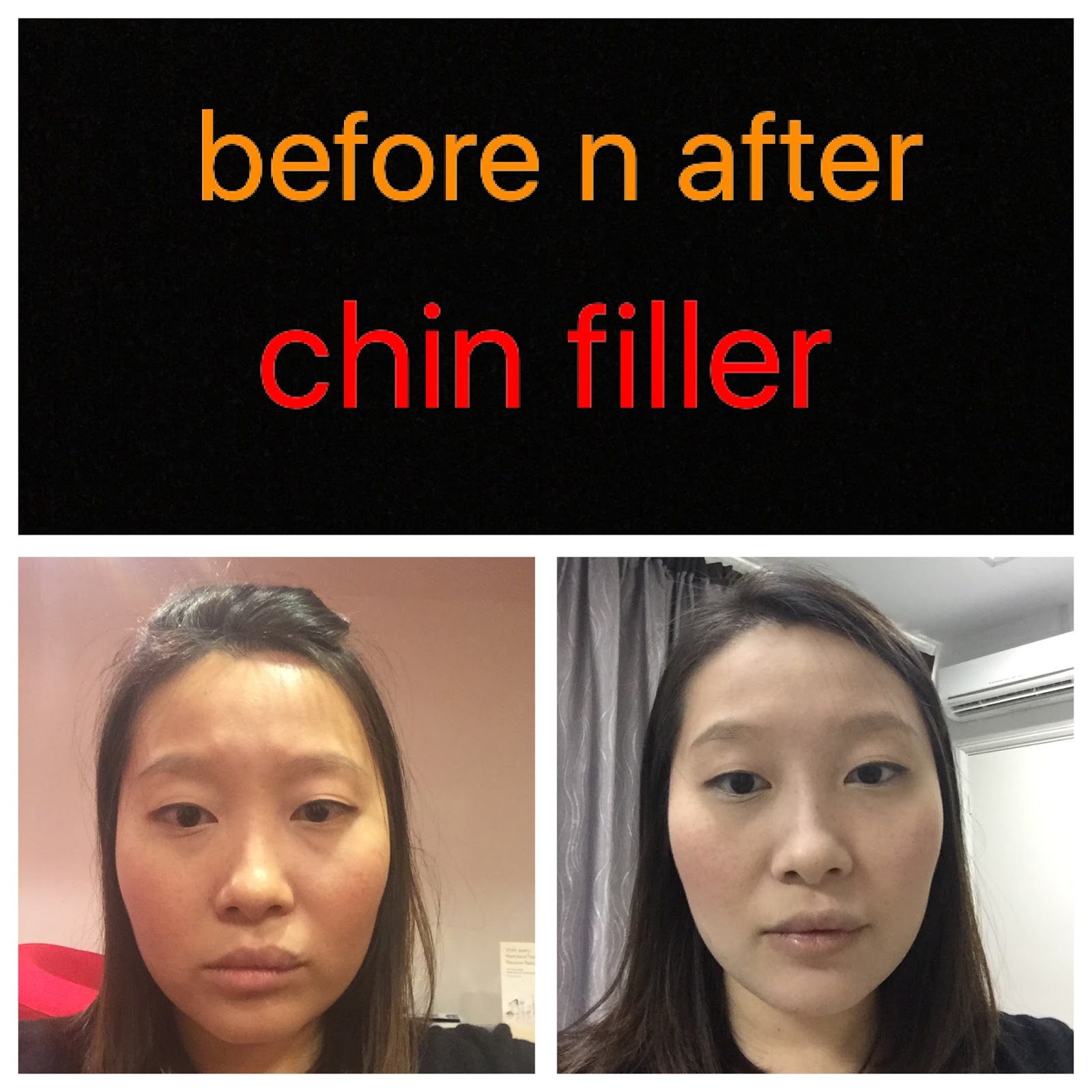 In search of beauty Chin Fillers (Nonsponsored Post)