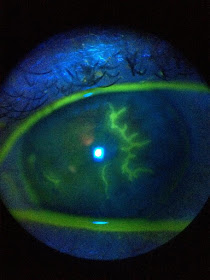 Eyedolatry: Five Things You Didn't Know About Pink Eye