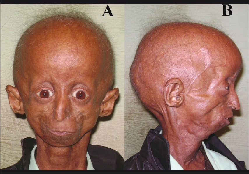 RESEARCH ON PROGERIA
