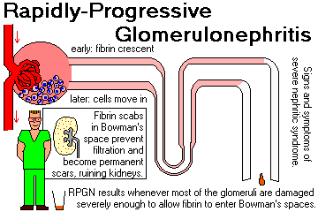 Glomerulonephritis definition , mechanism and clinical ... cast diagram questions 
