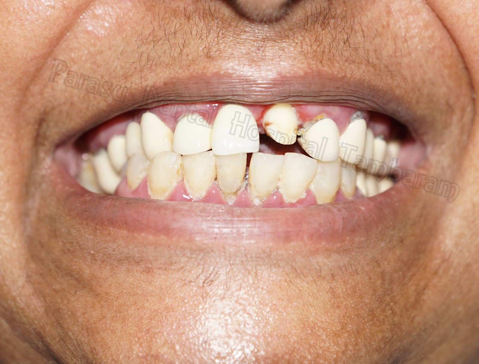 Dental Xray center in medavakkam Laser root canal with zirconium crown