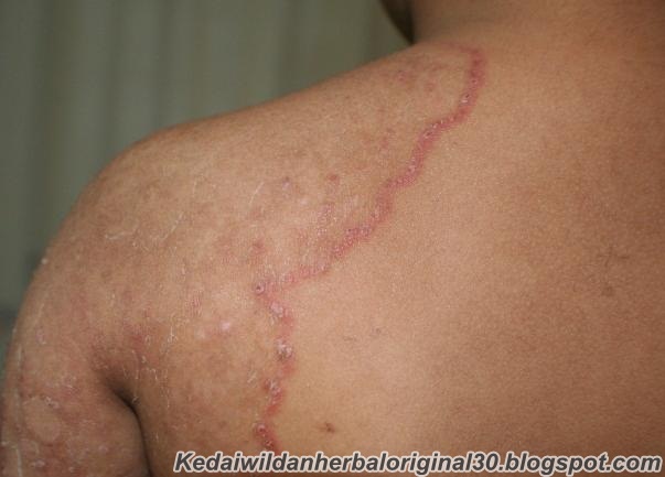 Cara Mengobati Kurap Kering Yang Melebar Dengan Cepat , TERBUKTI Ampuh