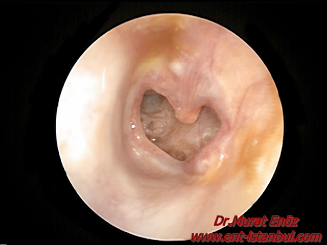 Ruptured eardrum - Traumatic ear drum perforation - Treatment of perforated eardrum - Eardrum repair Istanbul - Eardrum repair Turkey - Eardrum surgery in Istanbul - Eardrum hole operation in Turkey