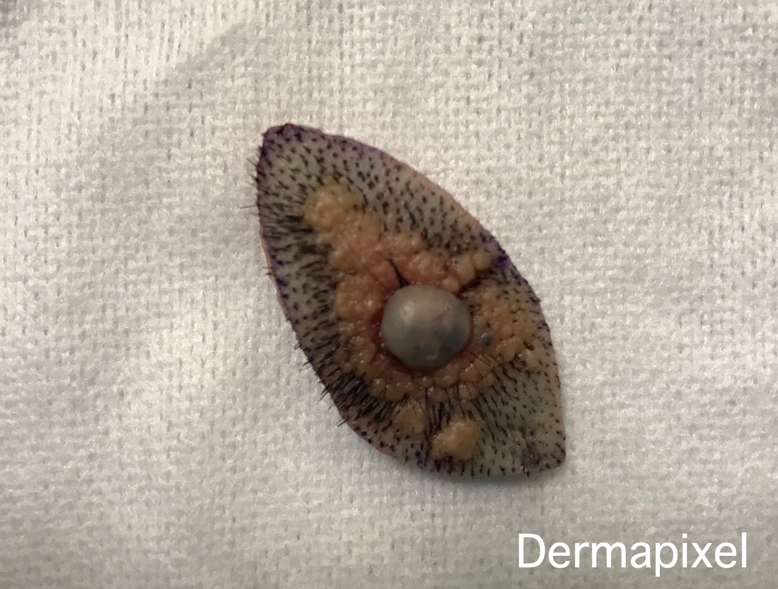 Nevus sebáceo de Jadassohn y carcinoma basocelular