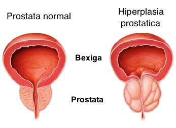 sintomas de próstata enferma sintomas de próstata enferma