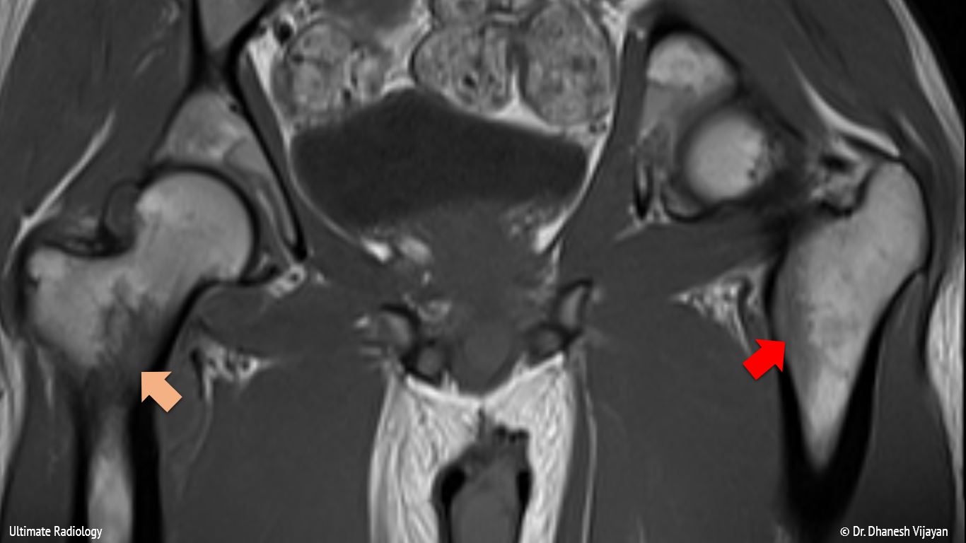 Ultimate Radiology Septic arthritis of hip joint