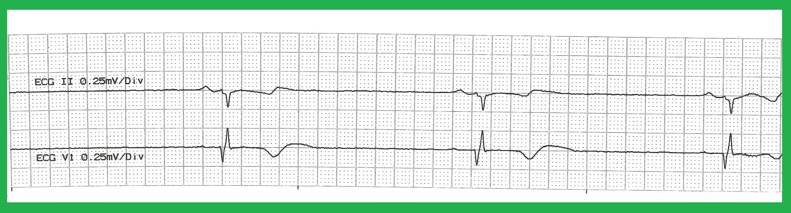 ekg pulseless electrical activity ekg pulseless electrical activity