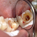 Mẹo điều trị sâu răng cho trẻ em hiệu quả 