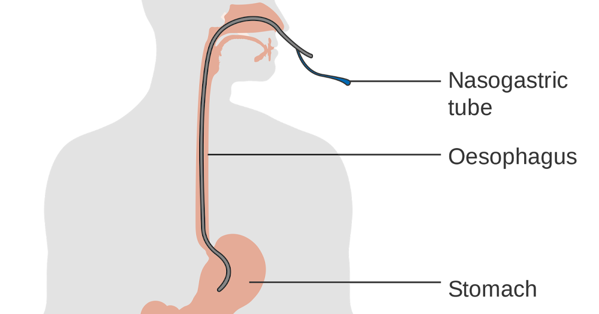 Cock feeding. Энтерал. Enteral feeding. Enteral мм2. Nasogastric Suction.