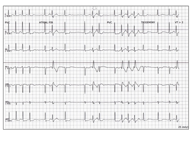 ECG Rhythms Aberrancy