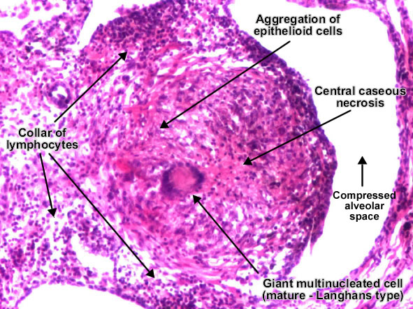 Histopathology showing necrotizing granulomatous 