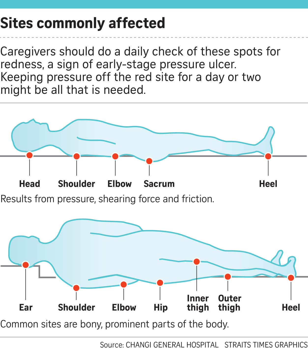 If Only Singaporeans Stopped to Think Pressure ulcers a pressing