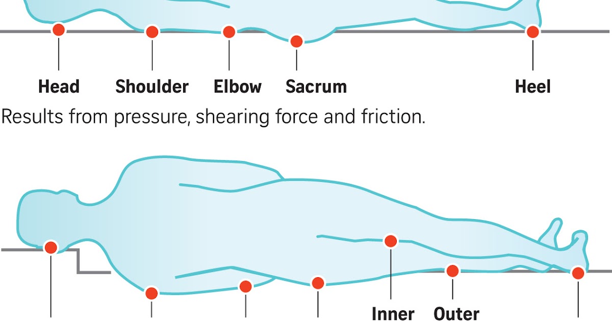 If Only Singaporeans Stopped to Think Pressure ulcers a pressing