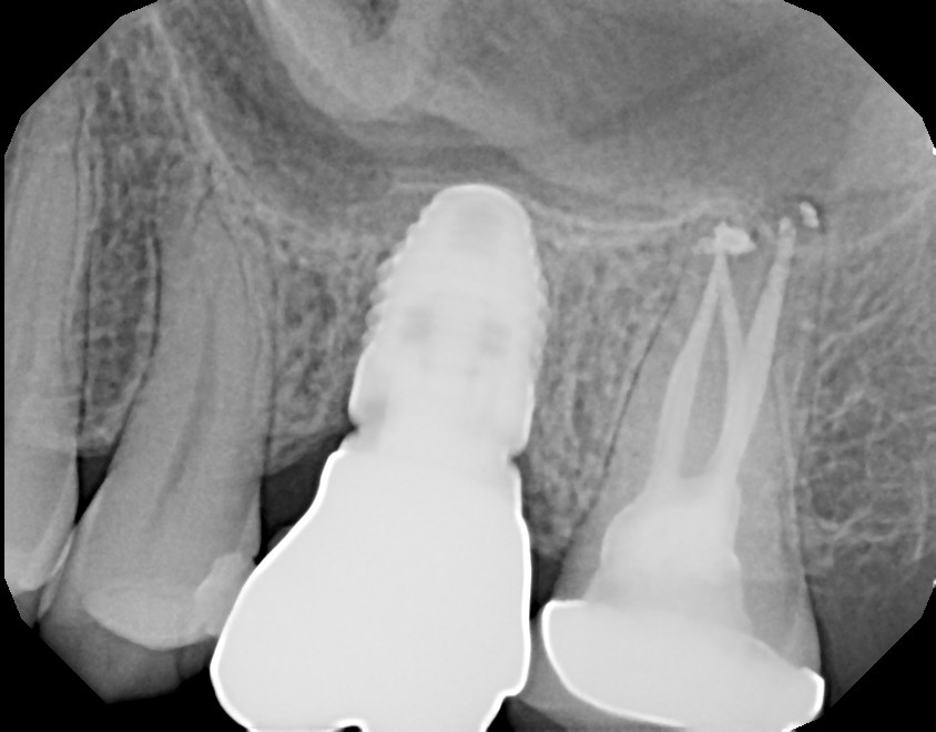 www-bestogdendentist-blog-tooth-still-hurts-after-root-canal-and