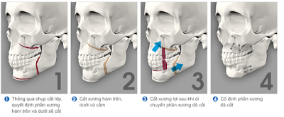 Cắt xương hàm móm như thế nào?