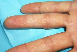 Causes of Peeling skin on hands and feet - RightDiagnosis.com