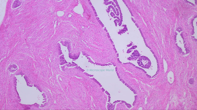 Breast fibroadenoma under the microscope at 40x.