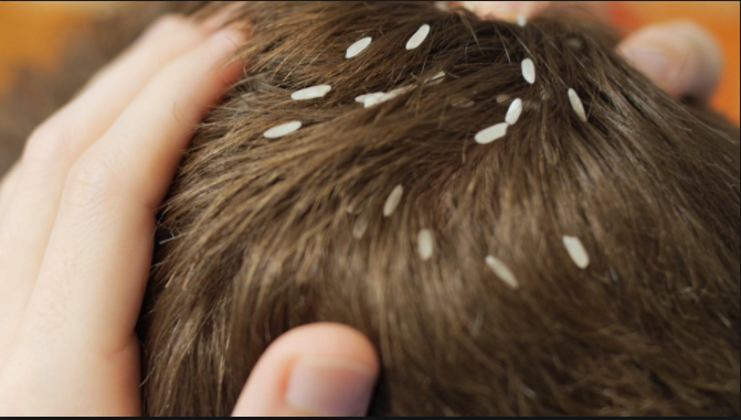 20 Ways To Get Rid Of Head Lice Daily Gossips Club