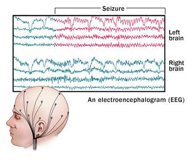 Science Inspiration: What is an Electroencephalogram-EEG?