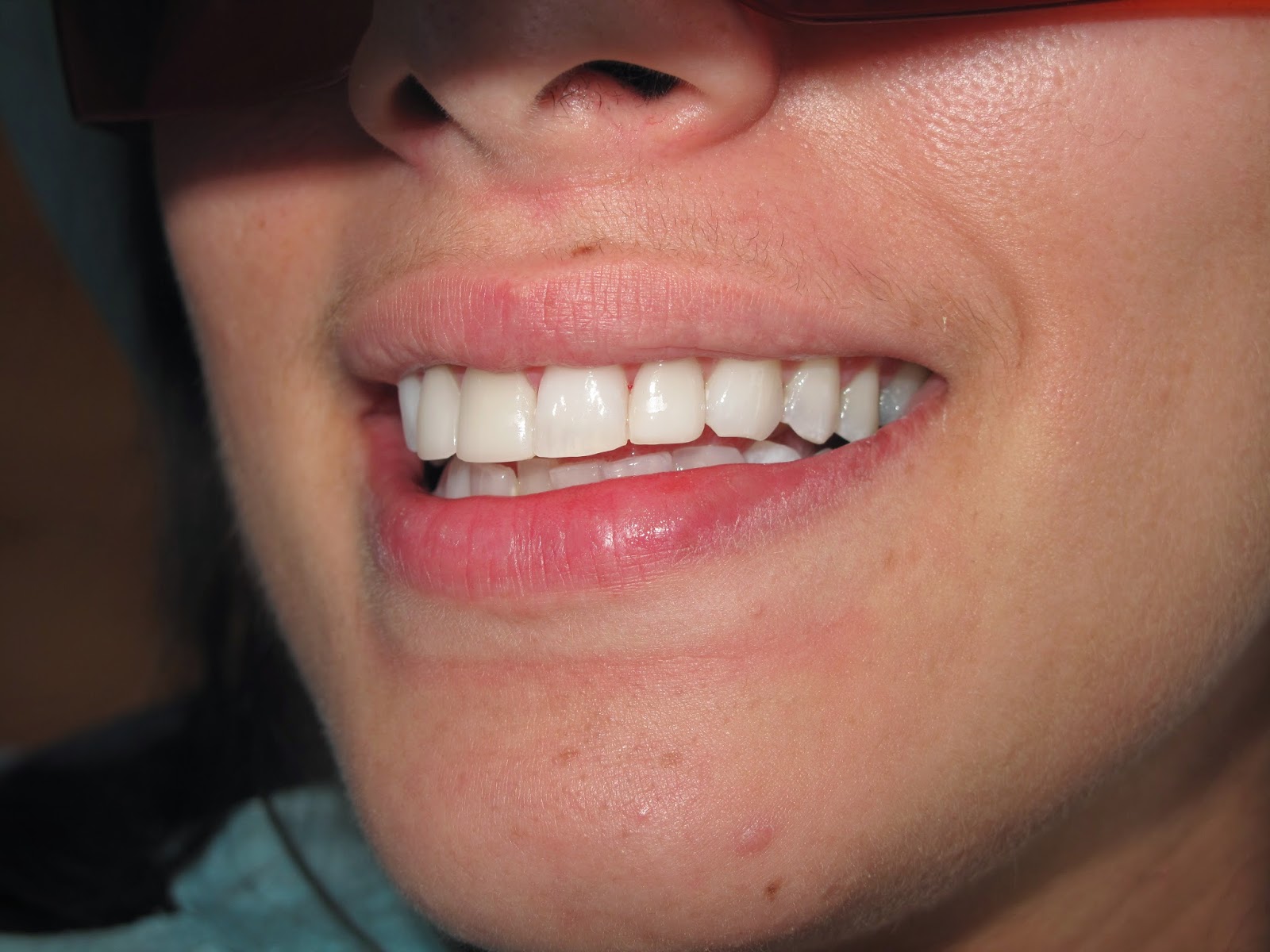 One of the best dental implants laser specialist surgeon in Lebanon