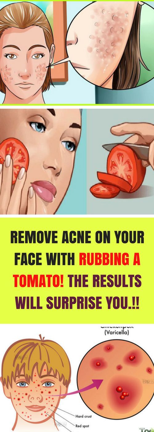 Let Start Slim Today Remove Acne On Your Face & Rubbing A Tomato. The