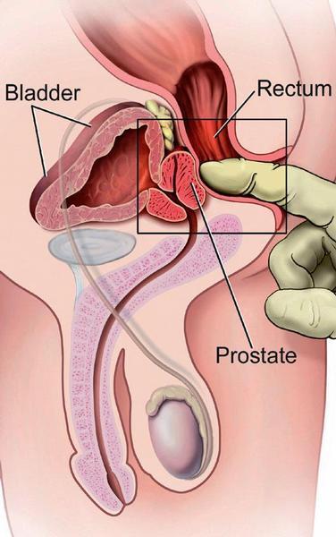 prostata dolore forte e sangue da