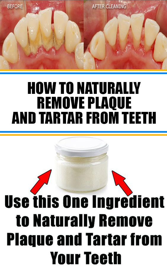 How to Naturally Remove Plaque and Tartar from Teeth