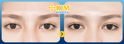 Khách hàng sở hữu đôi mắt to hơn sau khi thực hiện phẫu thuật mở rộng góc mắt.