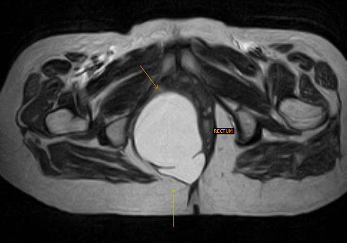 Perirectal CystDifferentials Sumer's Radiology Blog