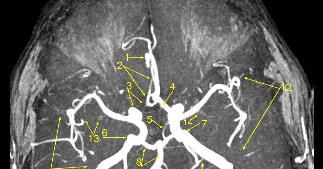 Сегмент а1 пма. Сегменты средней мозговой артерии мрт. Сегменты средней мозговой артерии на кт. Сегменты ВСА на кт. Сегменты передней мозговой артерии на кт.