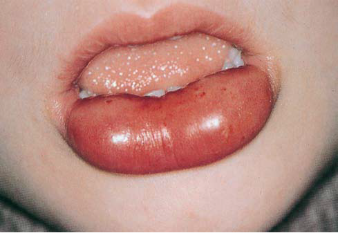 Oral steroids for skin rash side effects