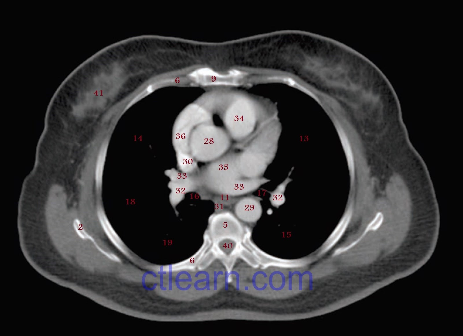 Learn CT Scan Anatomy CT Axial Chest