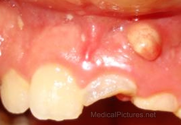 Abscessed Tooth Home Remedies, Complications & Extraction