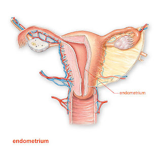 pengobatan endometriosis tanpa kuret