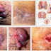 Benjolan di anus bernanah