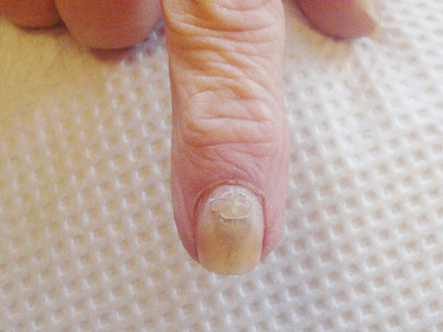 injured nail