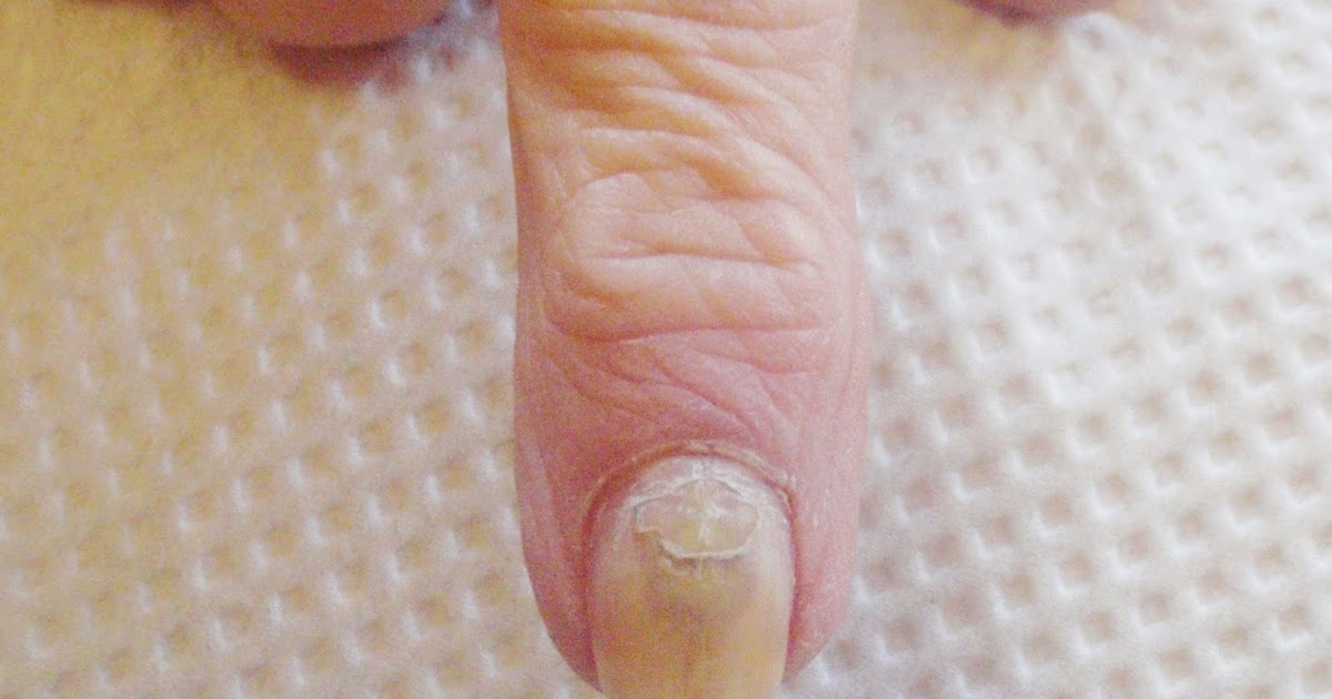 Bruised, Injured Nail is Falling Off