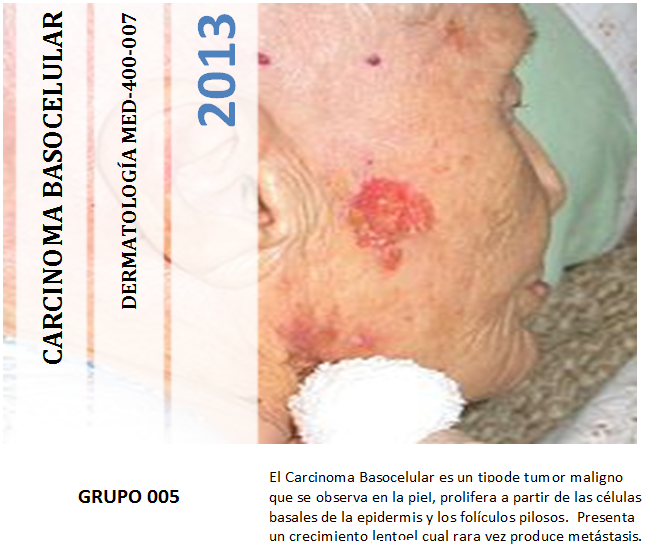 carcinoma basocelular de tipo nodular pigmentado