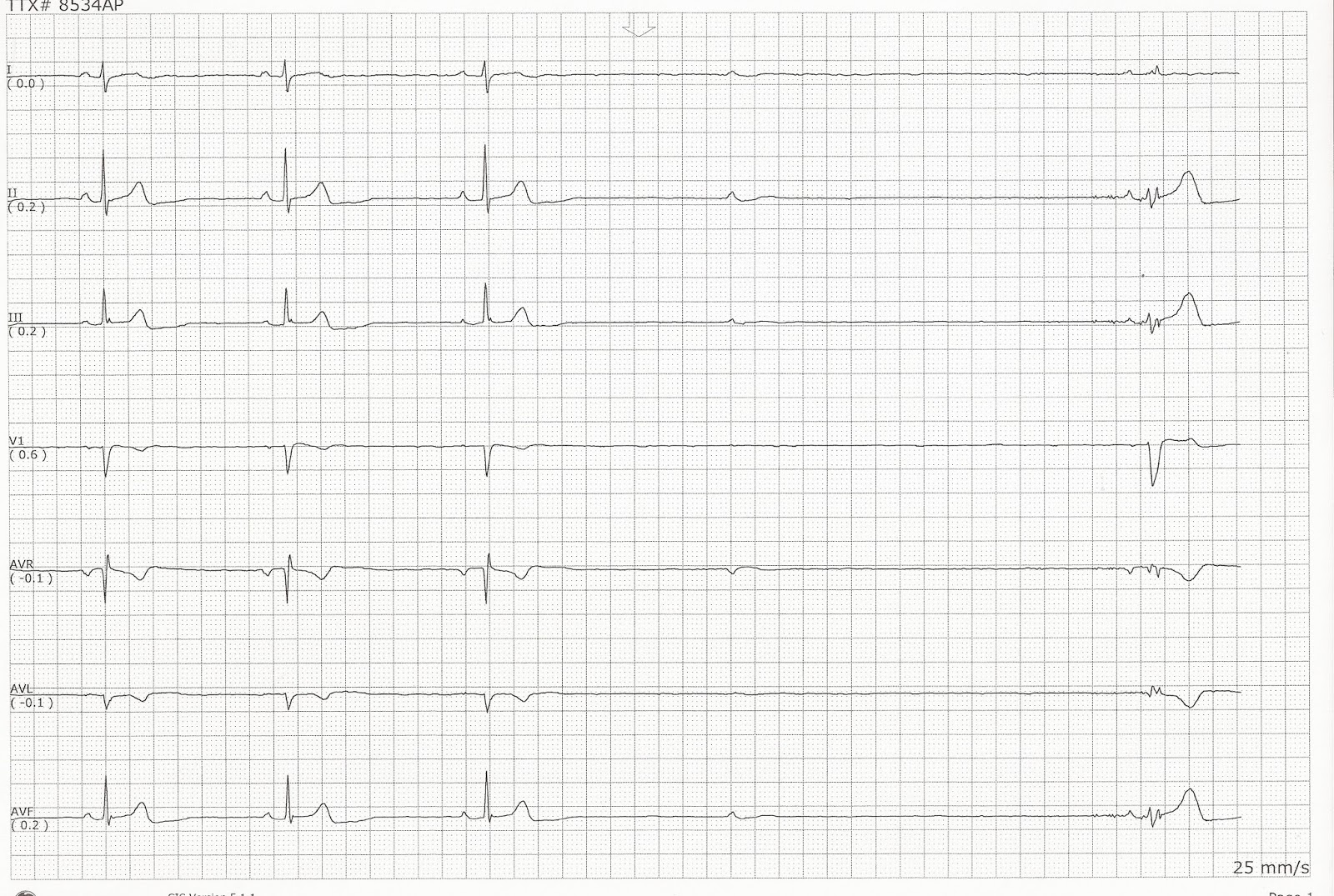 Sinus Bradycardia with a Dropped Beat and Sinus Srrest