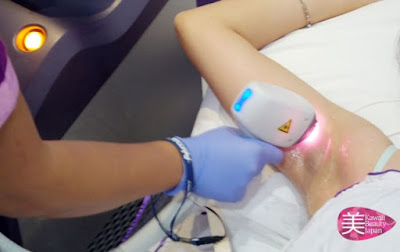 The laser process to remove armpit hair
