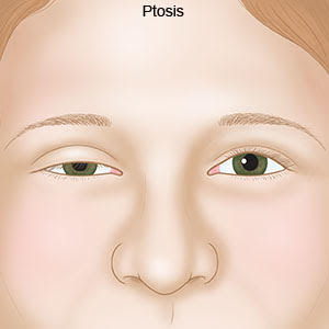 ptosis