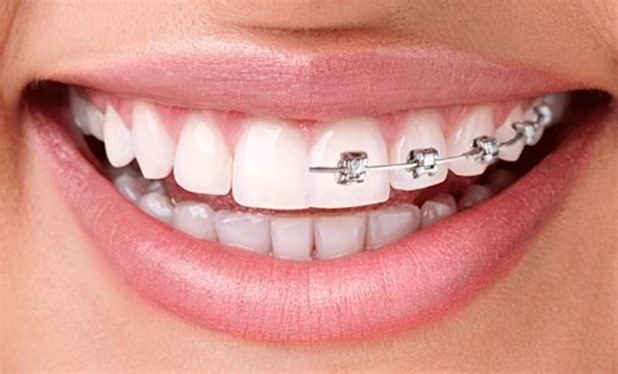 Greenbelt Dentist, teeth, caring for teeth, dental care, invisalign braces