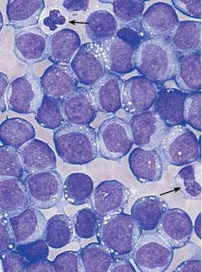 m5 marrow infiltration homogeneous bone leukemia fig 13c