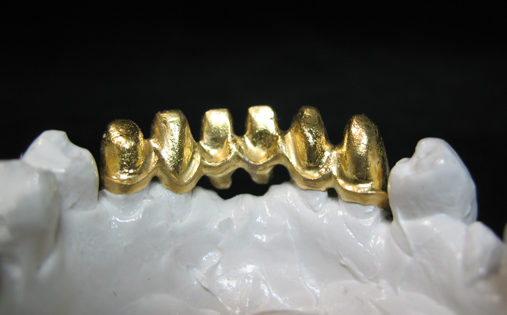 Золото коронки проба. Сплав золота 750 пробы в стоматологии. Золотоплатиновый сплав в стоматологии. Коронка металлокерамика (золотоплатиновый сплав). Зубная коронка из золота.