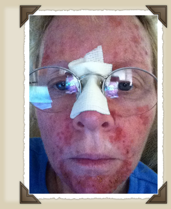 Just Thoughts on a Blog My Skin Cancer Journal