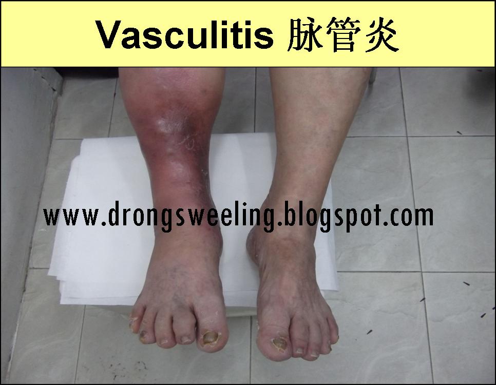 TCM News TCM Clinic Physician treat Vasculitis on Lower Legs