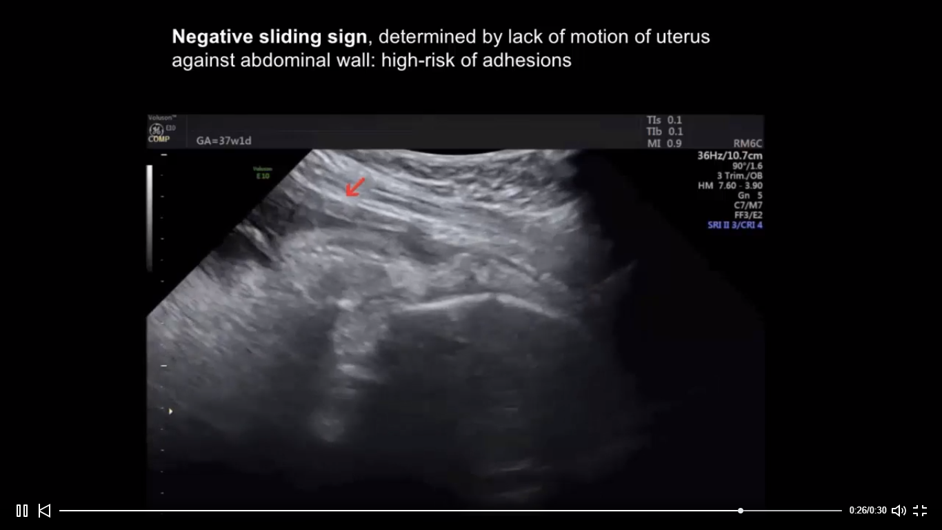 Ob/Gyn Updated Simple sonographic marker helps predicts the risk of
